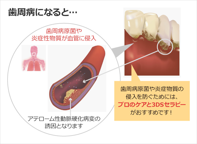歯周病になると…歯周病原菌や炎症性物質が血管に侵入